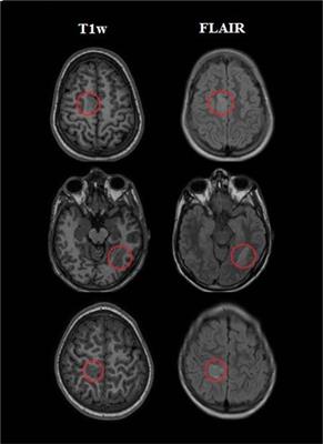 Frontiers | Automatic Detection Of Focal Cortical Dysplasia Type II In ...